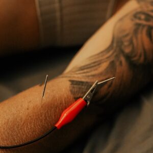 Acupuncture